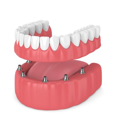 Prótesis sobre implantes