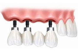 QF Laboratorio Dental implantes dentales